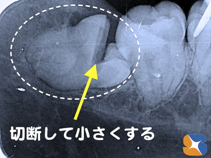横向きの親知らず　２分割