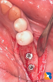 骨の増成後のインンプラント