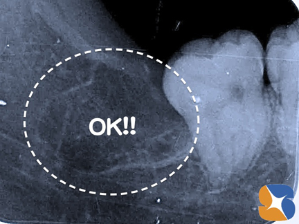 横向きの親知らず　東大阪　点滴