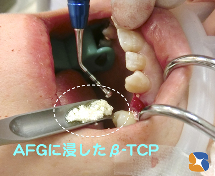 動物由来の人工の骨は使用しない