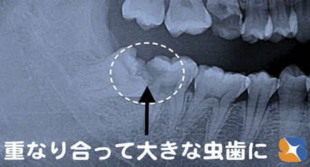 横向きの親知らず　重なり合う横の歯も大きな虫歯
