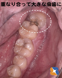 横向きの親知らずが原因で手前の歯も大きな虫歯