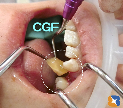 抜歯した痕にCGF