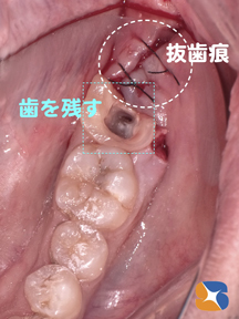 横向きの親知らずが原因で手前の歯も大きな虫歯