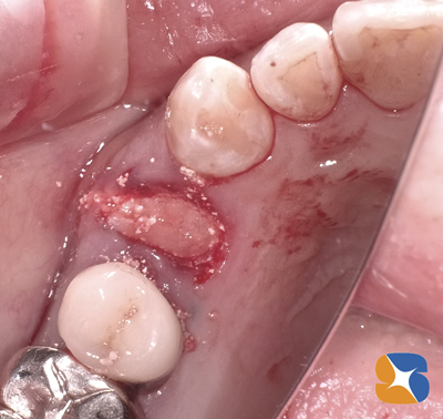 自己血液からCGFを分離　さらに粘膜を加工　全て自分の体の組織を利用　