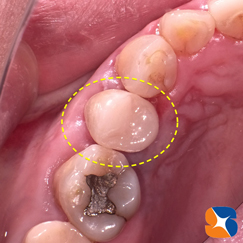 割れた歯を神経を抜かずにオールセラミックで治す