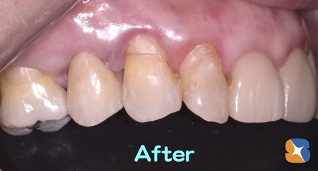 セレックを使って超短期間でオールセラミックを入れる