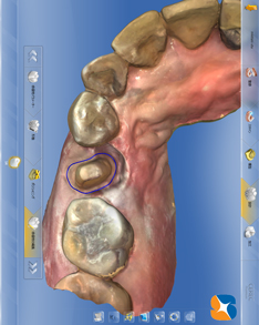 セレックでオールセラミックを超短期で治す