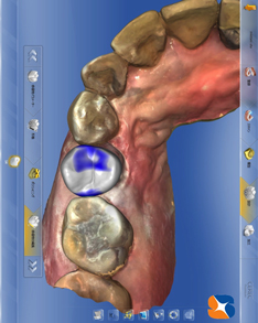 セレックでオールセラミックを超短期で低価格で治す