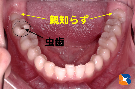 横向きの親知らず