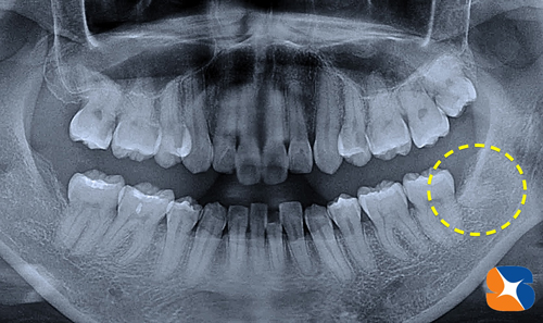 横向きの親知らずを静脈麻酔鎮静法で抜歯