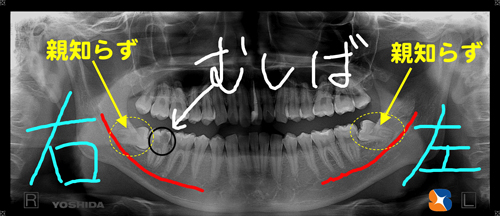 横向きの親知らず
