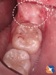 横向きの親知らずは歯肉に完全に覆われている超難抜歯