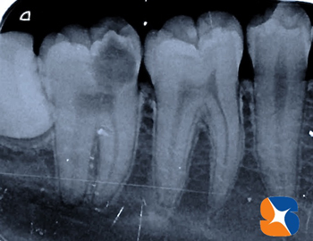 大きな虫歯の治療も同時に行う 大きな虫歯の治療も同時に行う