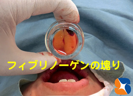 自己血液からフィブリンの塊りのみを製造