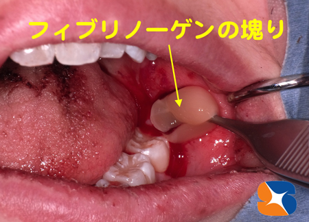 フィブリンの塊りを抜歯痕に入れて傷口早期回復　大幅な痛み軽減　