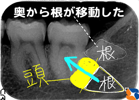 難し過ぎる親知らずの抜歯を静脈麻酔鎮静法で抜歯する