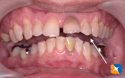 東大阪／奈良　横向きの親知らず