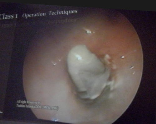 内視鏡を使って上顎のインプラント手術を成功させる