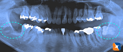 東大阪／奈良　横向きの親知らず