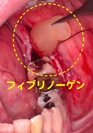 CGF  自己血液のフィブリノーゲン　再生医療