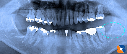 東大阪／奈良　横向きの親知らず