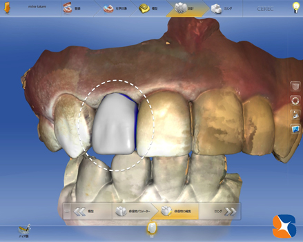 セレックで前歯のオールセラミックを制作