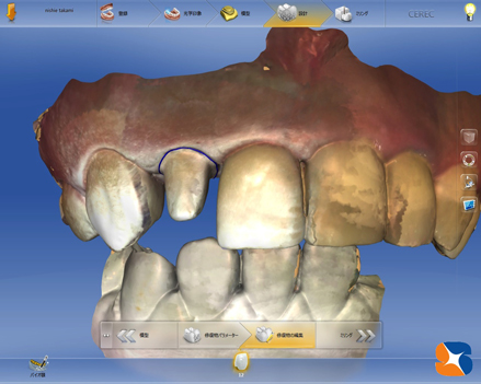 セレックでDr.鈴木が一から制作