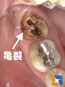 奥歯が真ん中で２分割　ヒビ