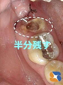 歯を２分割　状態の良い方を残し　状態の悪い方を抜歯