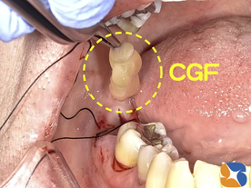 フィブリンの塊り（CGF）を抜歯痕に入れて早期回復　痛みの軽減　無料