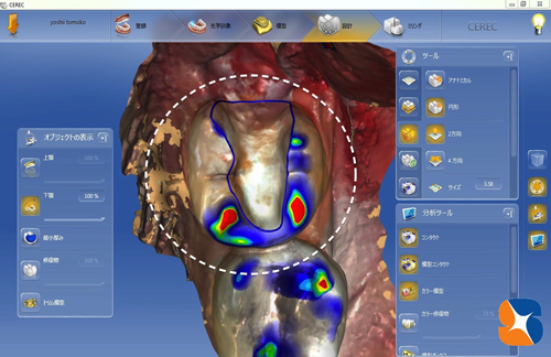 セレックで虫歯を一日で治す　保険で無痛鎮静法