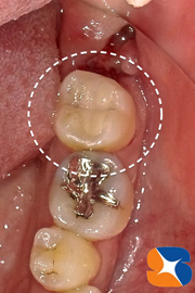 オールセラミックの詰め物　セレックで一日で完了　保険で無痛鎮静法