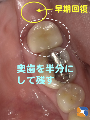 抜歯予定の歯を残す最先端医療と技術