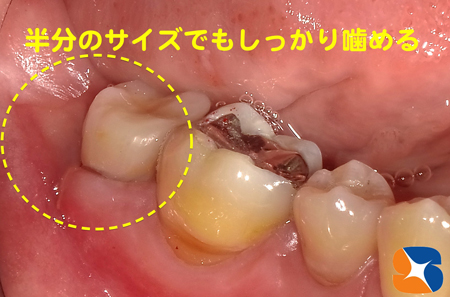 抜歯を宣告された歯を鈴木歯科で完全復活