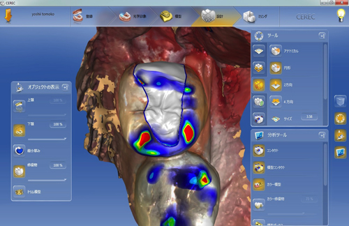 セレックでオールセラミックの詰め物　一日で完了　保険で無痛鎮静法
