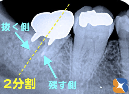 奥歯を二つに割って、残す側と抜く側に分ける