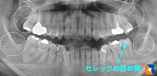 奈良＆大阪　保険の点滴　無痛抜歯　無痛むし歯治療