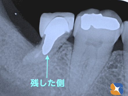 半分残した歯の根に金属の補強芯とセラミックの被せを装着