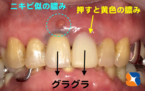 歯茎にニキビ　抜歯即インプラント
