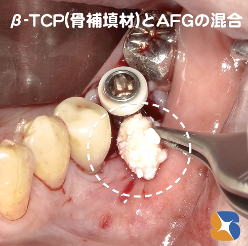 動物由来でない吸収性骨補填材