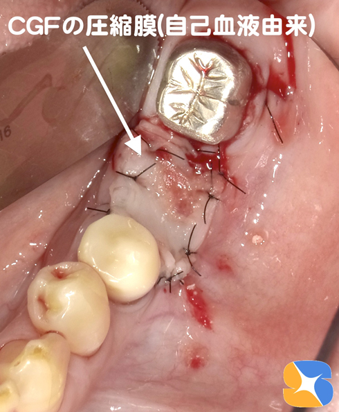 CGFを圧縮した膜で傷口を自然に封鎖