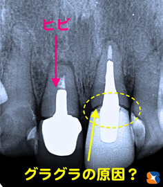 麻酔鎮静法　抜歯した日にインプラントのオペ