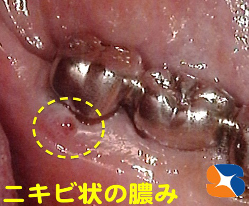 歯茎からニキビ状の凸起　押すと膿みが潰れるの繰り返し