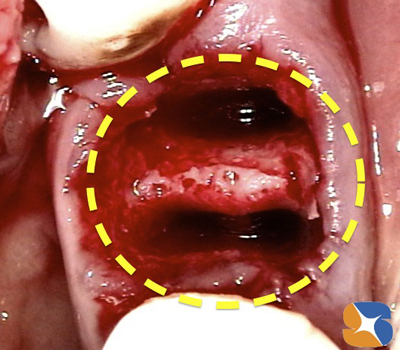 静脈鎮静法　無料サポート　抜歯とインプラント同日