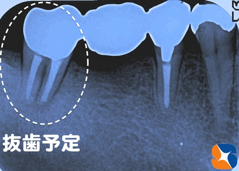 歯の根が割れている　抜歯した日にインプラントの手術