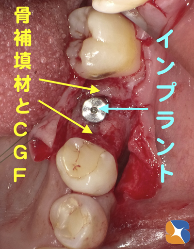 静脈鎮静法　無料サポート　抜歯とインプラント同日