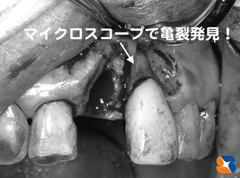 マイクロスコープで歯のヒビを発見