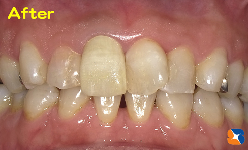 院長手製のセレックで作ったオールセラミックの前歯