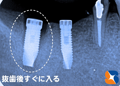 抜歯した日にインプラントが入る　恐くない無痛飲プランんと手術